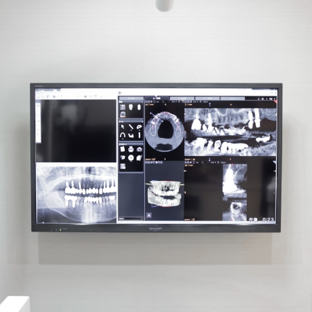 精密インプラント精密義歯(入れ歯)